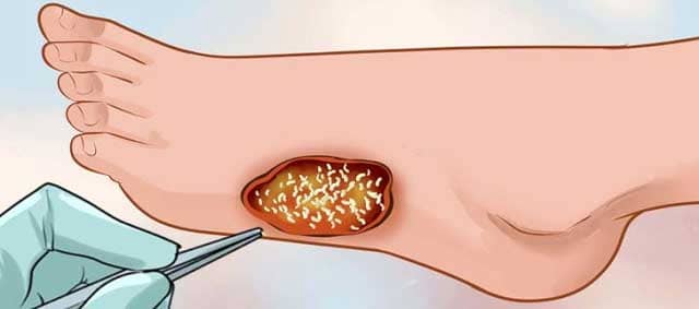 Larva Terapisi Uygulamaları